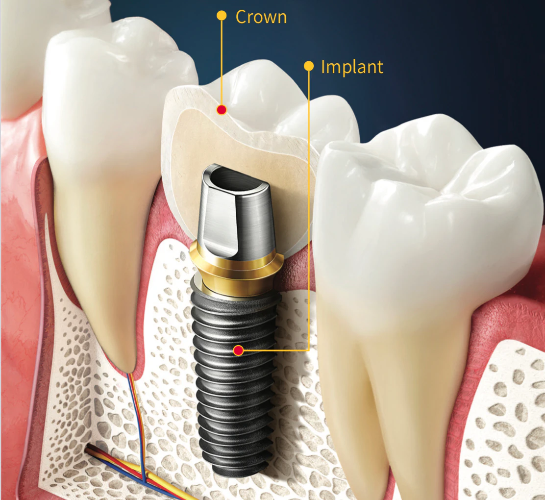 Dental Implants for Your Smile